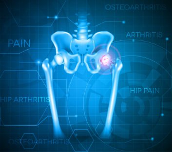 New York DePuy Hip Attorneys | Belluck & Fox, LLP Personal Injury Lawyers